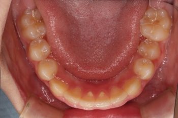 出っ歯と深い嚙み合わせの改善