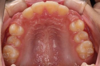 出っ歯と深い嚙み合わせの改善