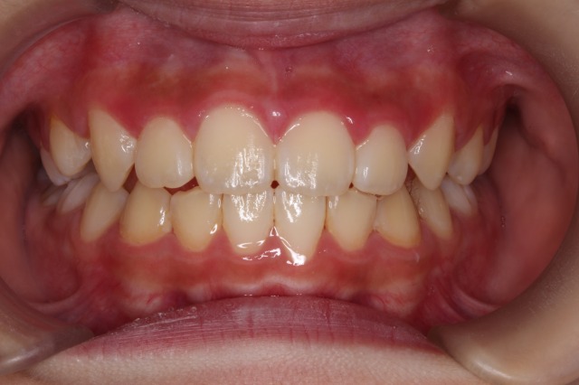 出っ歯の改善