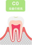 CO（シーオー）：初期虫歯