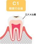 C1（シーワン）：エナメル質に達する虫歯