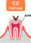 C2（シーツー）：象牙質に達する虫歯