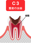 C3（シースリー）：神経に達する虫歯