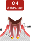 追加します。神経を取り除く処置が終わったら、状態が整い次第、詰め物や被せ物で歯質を補います。  C4（シーフォー）：歯根までボロボロになった虫歯